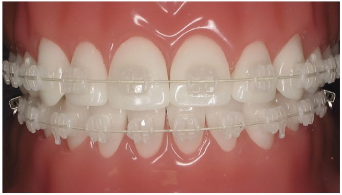 керамические брекеты