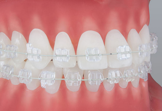 сапфировые брекеты