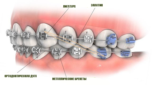 структура брекетов